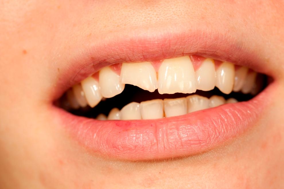 Descubre las Nuevas Tendencias en Reconstrucción Dental